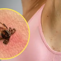 Gdzie siedzą kleszcze i jak ich unikać w popularnych miejscach