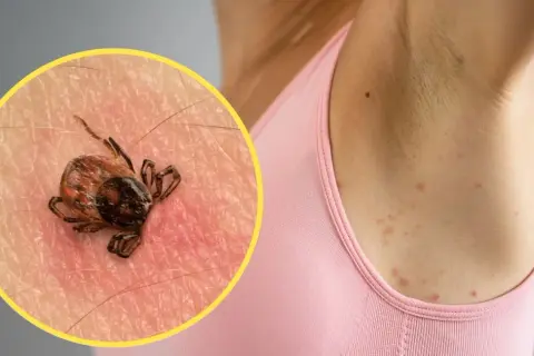Gdzie siedzą kleszcze i jak ich unikać w popularnych miejscach